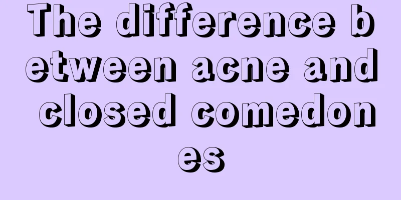 The difference between acne and closed comedones