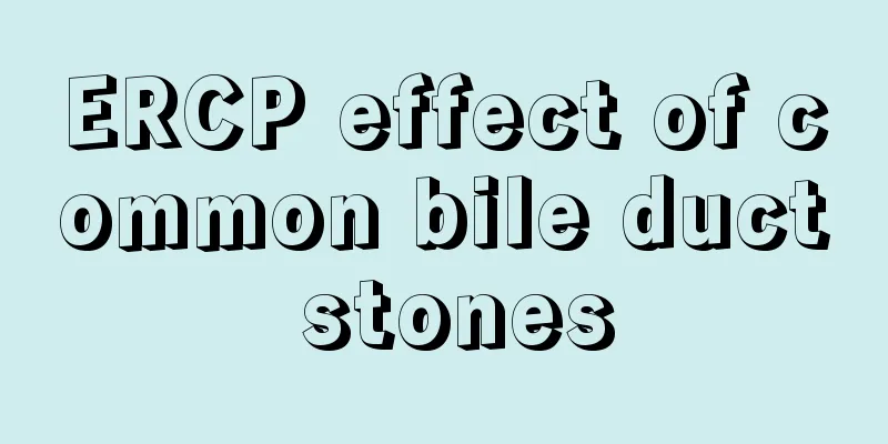 ERCP effect of common bile duct stones