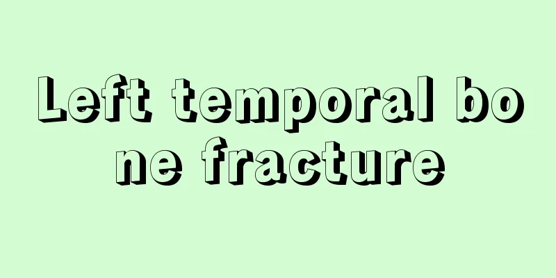 Left temporal bone fracture