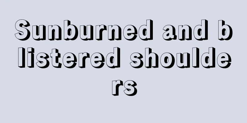 Sunburned and blistered shoulders