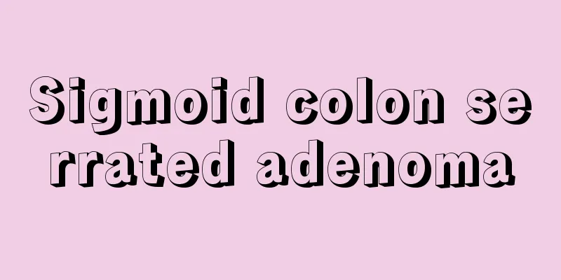 Sigmoid colon serrated adenoma