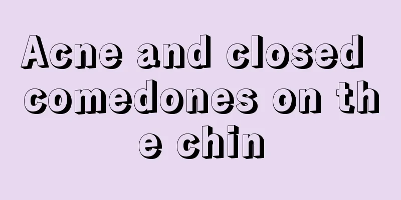 Acne and closed comedones on the chin