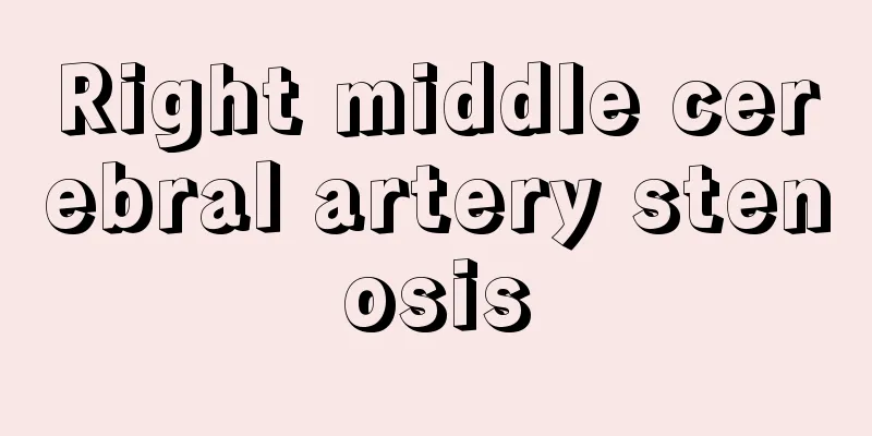 Right middle cerebral artery stenosis