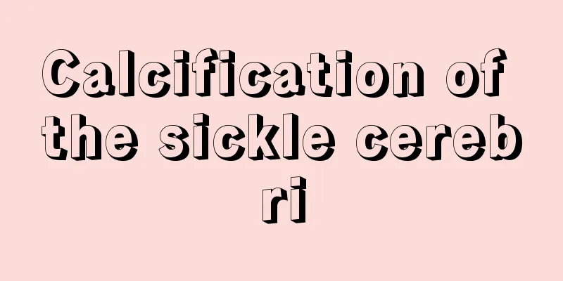 Calcification of the sickle cerebri