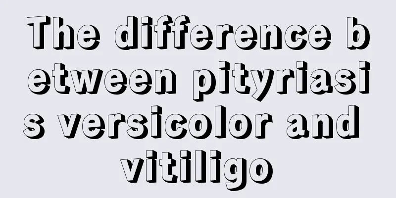 The difference between pityriasis versicolor and vitiligo