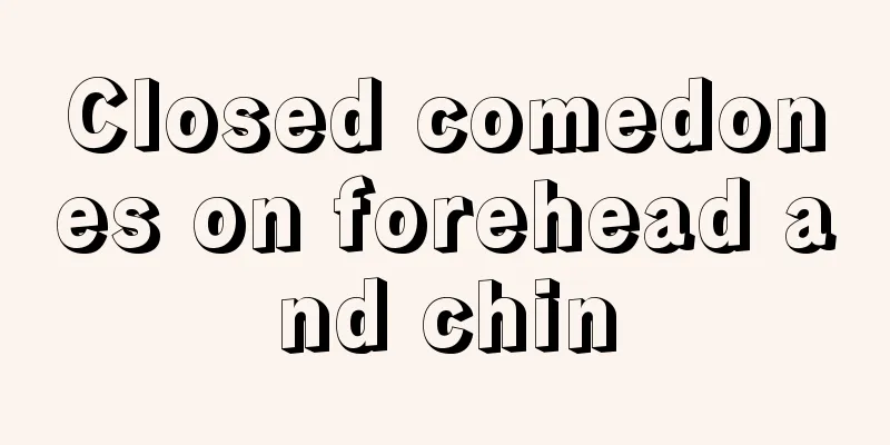 Closed comedones on forehead and chin