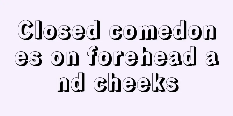 Closed comedones on forehead and cheeks