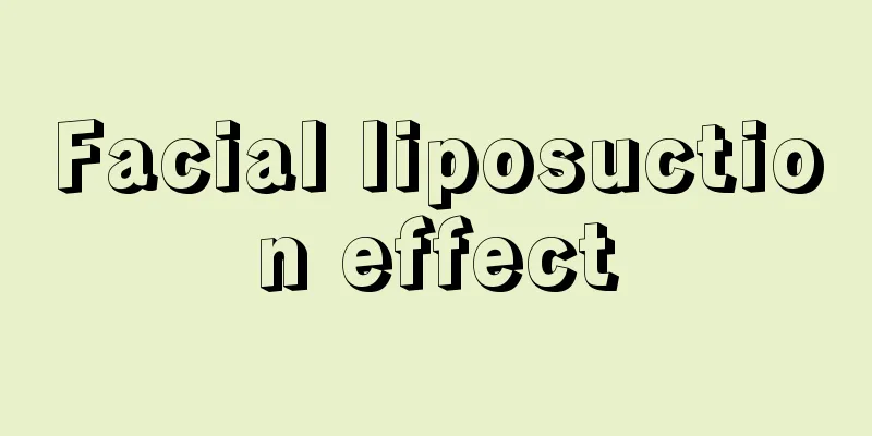 Facial liposuction effect