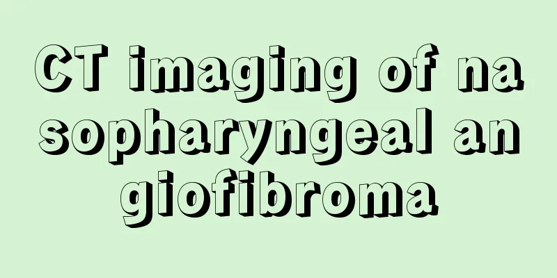 CT imaging of nasopharyngeal angiofibroma
