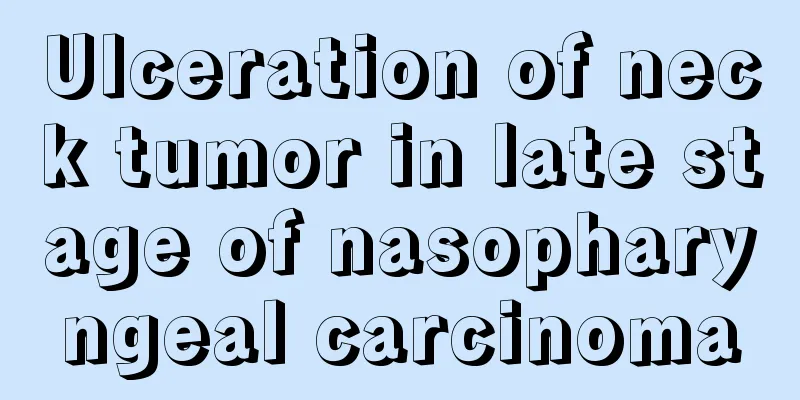 Ulceration of neck tumor in late stage of nasopharyngeal carcinoma
