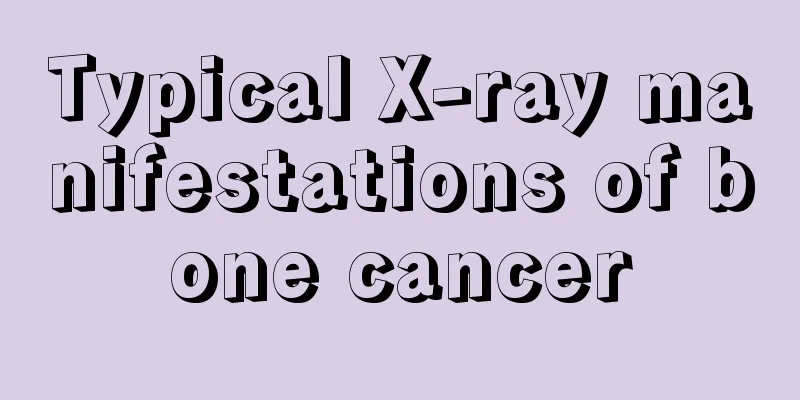 Typical X-ray manifestations of bone cancer