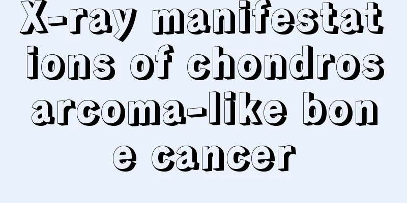 X-ray manifestations of chondrosarcoma-like bone cancer