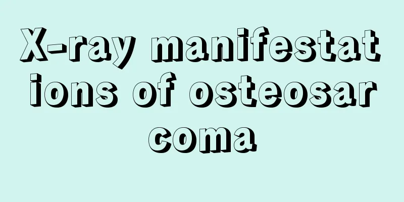 X-ray manifestations of osteosarcoma